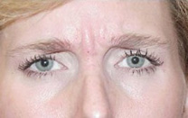 botox_eye treatments
