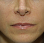 After radiesse_skin treatment results Frown lines after Radiesse treatment injections