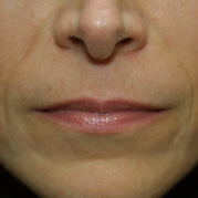 Before radiesse skin treatment dr. Frown lines before Radiesse treatment injections