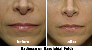 Radiesse before and after