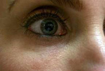 radiesses_injections-eye lid area after results Lower eyelid after Radiesse treatment injections
