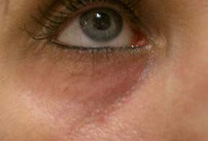 radiesses_injections-eye lid area before Lower eyelid before Radiesse treatment injections