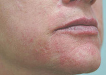 Results restylane-skin rejuvenation treatment center