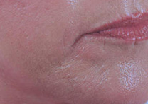 before restylane-injection treatments_laugh line