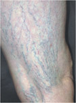Clinical Stages of Spider Veins