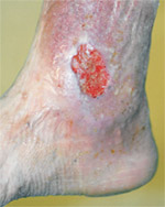 Clinical Stages of Vein Disease: Class 5-6 “Leg Ulcers”
