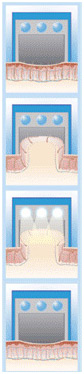 hair-removal-proceedure