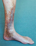 Clinical Stages of Vein Disease: Class 4 “Skin Changes”