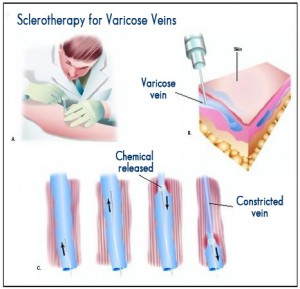 Sclerotherapy at St Louis Vein Center for Varicose Veins - How the Procedure Works