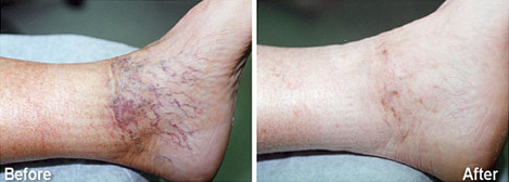spider-veins-removal