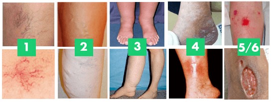 stages of venous insufficiency
