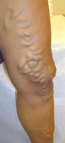 Varicose Vein 