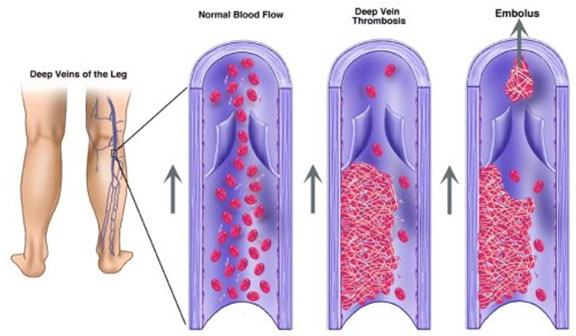 deep vein thrombosis symptoms