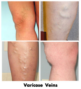 varicose-veins-treatment