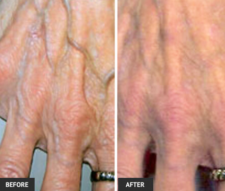 hand vein removal before and after