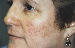 Facial Veins Picture