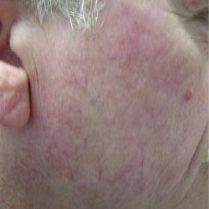 cheek vein after Veinwave Broken-blood-vessels-on-face