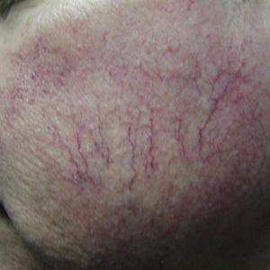 facial cheek veins before treatment Facial-Vein-Treatments