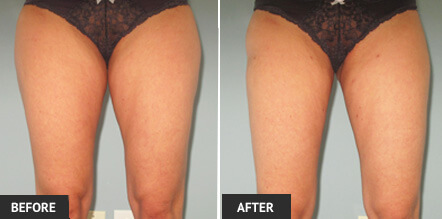liposuction with laser