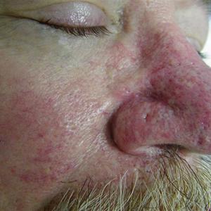 nose vein after veinwave treatment Facial-Vein-Treatments