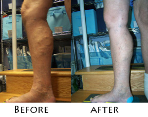 Varicose veins before & after EVLT Varicose veins before & after EVLT