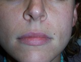 Frown lines after Radiesse treatment injections