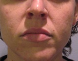 Frown lines before Radiesse treatment injections