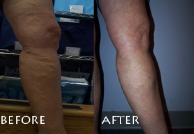 Varicose veins before & after sclerotherapy treatment Varicose veins before & after sclerotherapy treatment