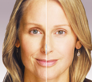 Before and After Juvederm Injections - St Louis Cosmetic Surgery Center
