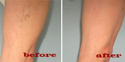sclerotherapy on varicose veins