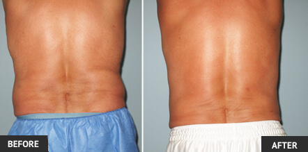 Before and After Pictures of Back Liposuction