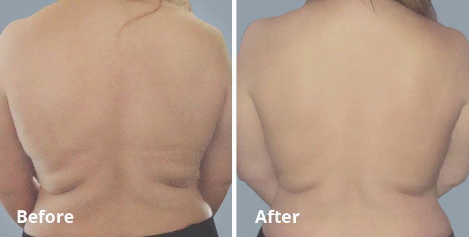 Body Contouring St Louis Before and After