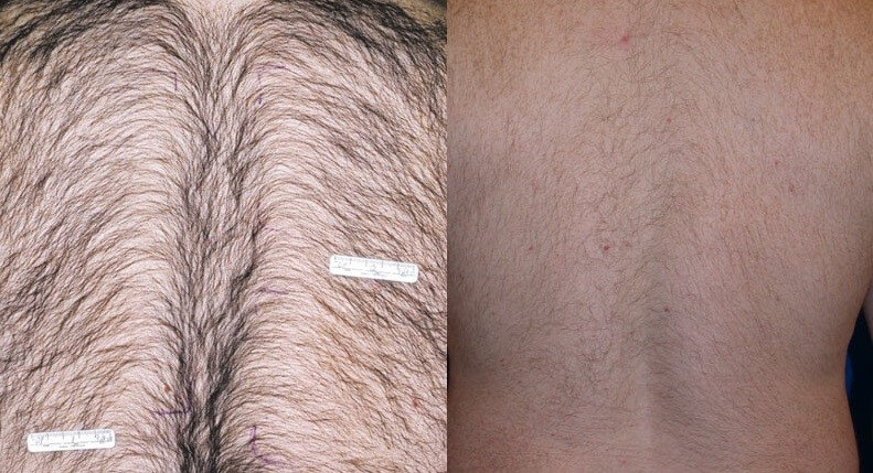 Before and After Diolaze Laser Hair Removal In St Louis