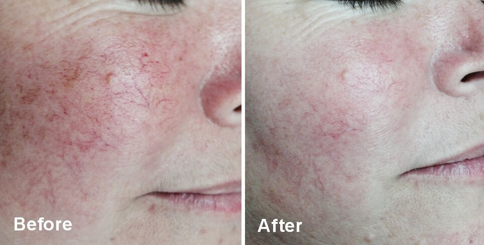 Before and After lumecca skin treatment procedure - Our St Louis Skin Solutions