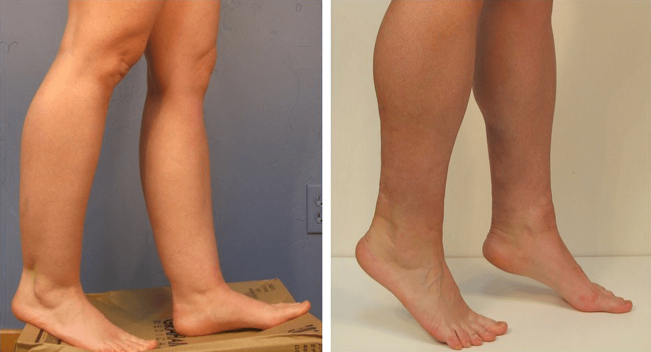 calf liposuction ankle reduction ankles patient cankles before calves surgery results female louis