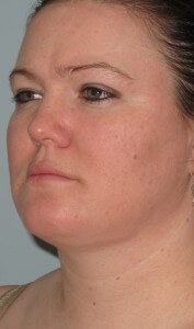 female chin after liposuction