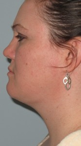 Neck Lift Cost St Louis semashow