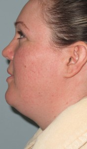 female chin before
