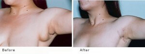Under arm lipo before and after picture.