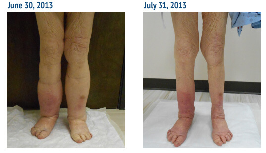 lymphedema st louis before and after
