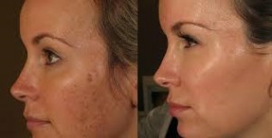 Before and After PRP Injection Therapy in St Louis