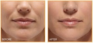 Facial Filler with PRP Injection therapy - Before and After