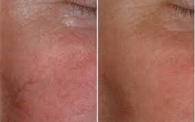 Another Look at our PRP Injection Therapy Results