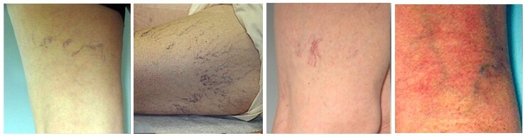 differences between spider veins and varicose veins picture