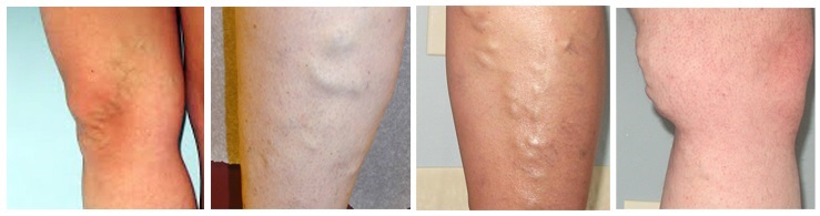 Varicose veins and spider veins differences