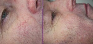 spider veins on face before and after treatment