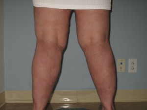 calf liposuction