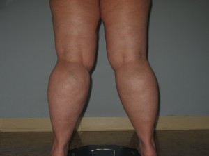 calf liposuction