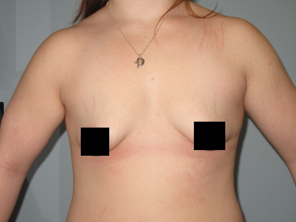 breast augmentation in st louis