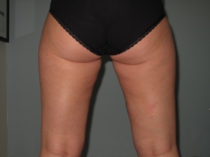 thighs Posterior after